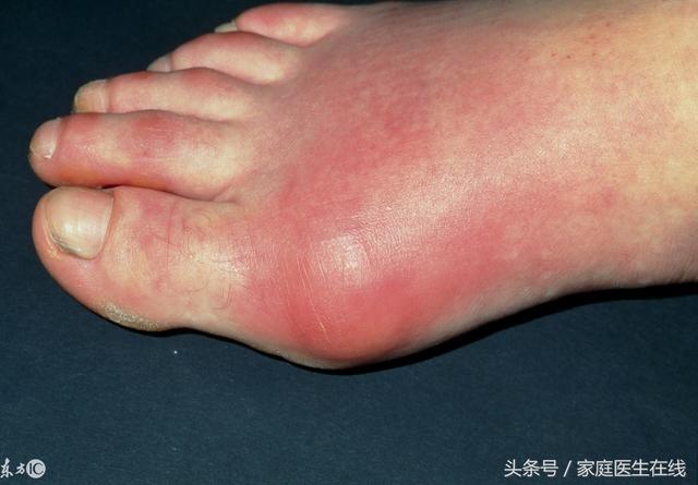 痛风患者可以喝咖啡吗?这些年,咖啡承受的误解实在太多了!